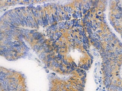Phospho-SHP2 (Tyr542)[Tyr546] Antibody - AF3412 at 1/100 staining human colon carcinoma by IHC-P.