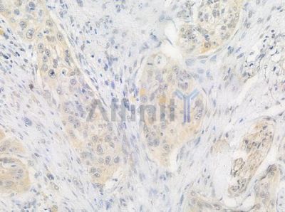 Phospho-FOXO1A (Ser329) Antibody - AF3416 at 1/100 staining human tongue carcinoma by IHC-P.