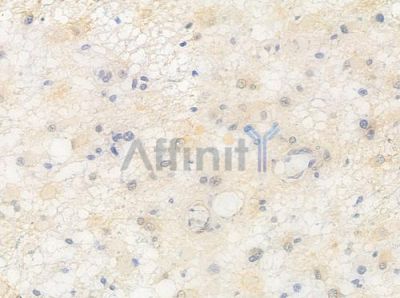 Phospho-FOXO1A (Ser329) Antibody - AF3416 at 1/100 staining human astrocytoma by IHC-P.