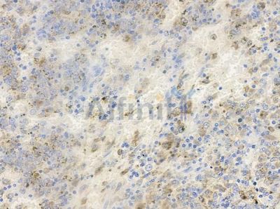 Phospho-PAK1 (Thr212) Antibody - AF3424 at 1/100 staining human melanoma by IHC-P.