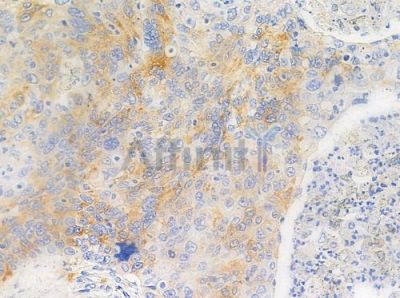 Phospho-Caspase 8 (Ser347) Antibody - AF3442 at 1/100 staining human esophageal carcinoma by IHC-P.