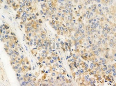 Phospho-PKD1/2/3/PKC mu (Ser738+Ser742) Antibody - AF3444 at 1/100 staining human prostate carcinoma by IHC-P.
