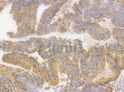Phospho-PKD1/2/3/PKC mu (Ser738+Ser742) Antibody - AF3444 at 1/100 staining human colon carcinoma by IHC-P.