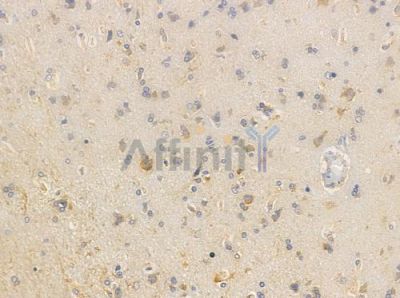 Phospho-PKD1/2/3/PKC mu (Ser738+Ser742) Antibody - AF3444 at 1/100 staining human glioblastoma by IHC-P.