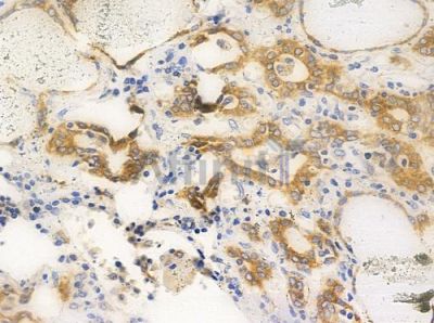 Phospho-PKD1/2/3/PKC mu (Ser738+Ser742) Antibody - AF3444 at 1/100 staining human thyroid carcinoma by IHC-P.