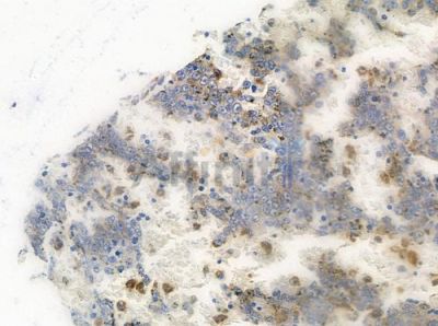 Phospho-IKB beta (Ser19) Antibody - AF3448 at 1/100 staining human melanoma by IHC-P.