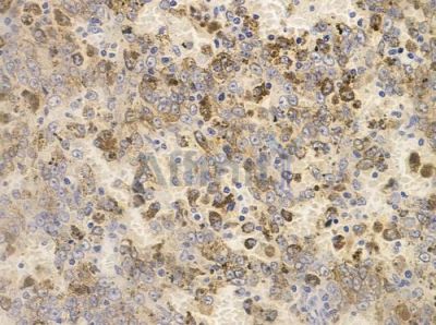 Phospho-Smad2 (Ser250) Antibody - AF3450 at 1/100 staining human melanoma by IHC-P.