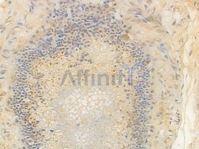 FOXP1 Antibody - AF4082 at 1/100 staining human testicular cancer by IHC-P.