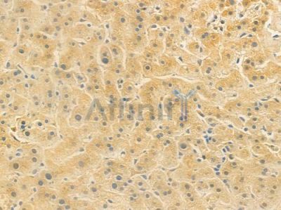 LGR5 Antibody - AF4102 at 1/100 staining human hepatocellular carcinoma by IHC-P.