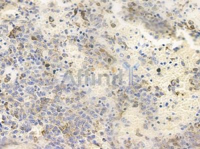 Phospho-PCAF (Tyr729) Antibody - AF4332 at 1/100 staining human melanoma by IHC-P.