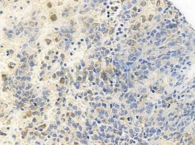 Phospho-NAKED1 (Ser348) Antibody - AF4346 at 1/100 staining human melanoma by IHC-P.