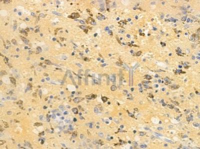 Phospho-Tuberin/TSC2 (Tyr1571) Antibody - AF4438 at 1/100 staining human melanoma by IHC-P.