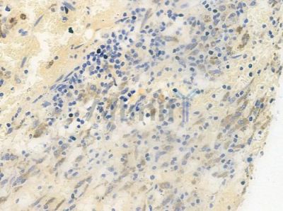 Phospho-BMX (Tyr40) Antibody - AF4444 at 1/100 staining human melanoma by IHC-P.