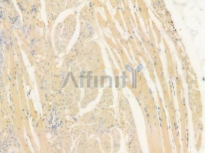 Phospho-Scribble (Ser1220) Antibody - AF4471 at 1/100 staining human tongue carcinoma by IHC-P.