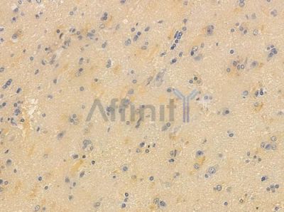 Phospho-Scribble (Ser1220) Antibody - AF4471 at 1/100 staining human glioblastoma by IHC-P.