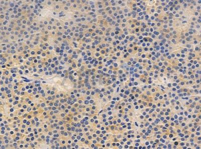 Phospho-Scribble (Ser1220) Antibody - AF4471 at 1/100 staining human pituitary adenoma by IHC-P.