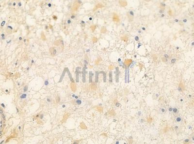 Phospho-Scribble (Ser1220) Antibody - AF4471 at 1/100 staining human astrocytoma by IHC-P.