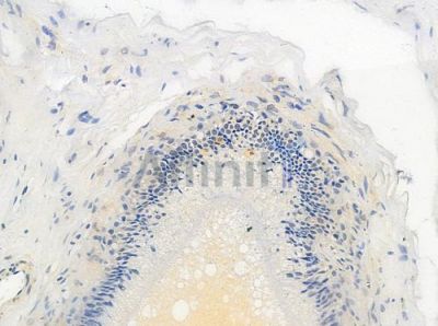 Phospho-BACH1/BRIP1 (Thr1133) Antibody - AF4489 at 1/100 staining human small cell lung carcinoma by IHC-P.