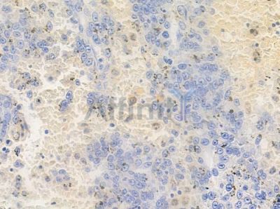 Phospho-CDCP1 (Tyr707) Antibody - AF4492 at 1/100 staining human melanoma by IHC-P.
