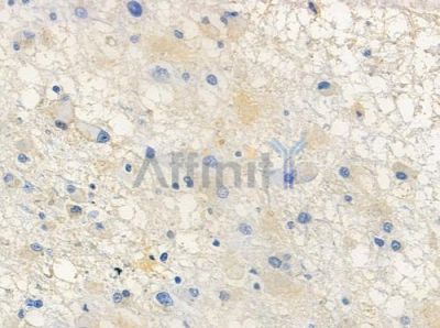 Phospho-CDCP1 (Tyr743) Antibody - AF4493 at 1/100 staining human astrocytoma by IHC-P.