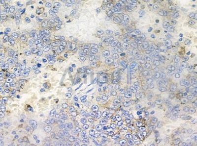 Phospho-CDCP1 (Tyr806) Antibody - AF4494 at 1/100 staining human melanoma by IHC-P.