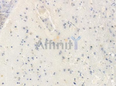 Phospho-RanBP3 (Ser126) Antibody - AF4495 at 1/100 staining human glioblastoma by IHC-P.