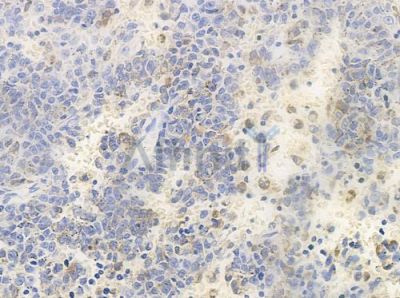 Phospho-NudC (Ser326) Antibody - AF4504 at 1/100 staining human melanoma by IHC-P.
