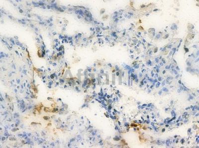 CD79B Antibody - AF4649 at 1/100 staining human lung squamous cell carcinoma by IHC-P.