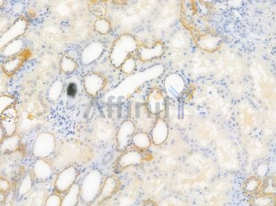 CAD Antibody - AF4715 at 1/100 staining human renal cell carcinoma by IHC-P.