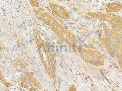 MYH9 Antibody - AF4725 at 1/100 staining human tongue carcinoma by IHC-P.