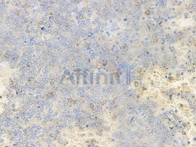 RAD18 Antibody - AF4797 at 1/100 staining human melanoma by IHC-P.
