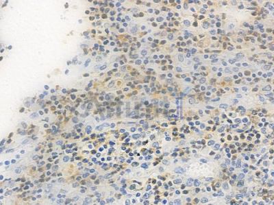 GATA6 Antibody - AF5270 at 1/100 staining human colon carcinoma by IHC-P.