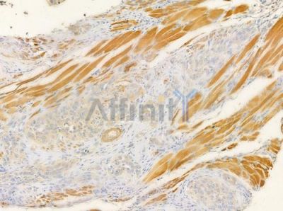ACTG2 Antibody - AF5351 at 1/100 staining human tongue carcinoma by IHC-P.