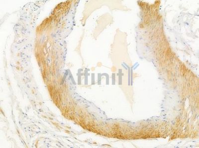 ACTG2 Antibody - AF5351 at 1/100 staining human testicular cancer by IHC-P.