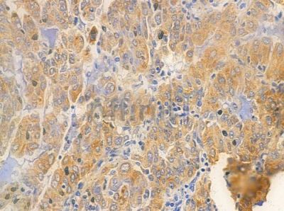 Cyclin F Antibody - AF5357 at 1/100 staining human lung adenocarcinoma by IHC-P.