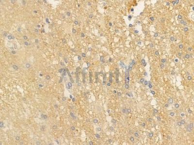 MRLC1 Antibody - AF5423 at 1/100 staining human glioblastoma by IHC-P.