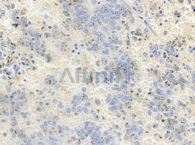 Phospho-Dematin (Ser403) Antibody - AF5424 at 1/100 staining human melanoma by IHC-P.