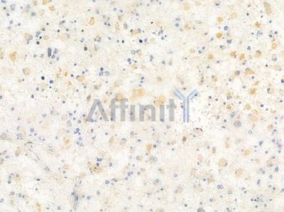 p15 INK4b Antibody - AF5486 at 1/100 staining human astrocytoma by IHC-P.