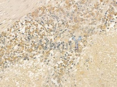 HER2/ErbB2 Antibody - AF6070 at 1/100 staining human prostate carcinoma by IHC-P.