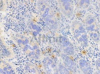 c-Jun Antibody - AF6089 at 1/100 staining human colon carcinoma by IHC-P.