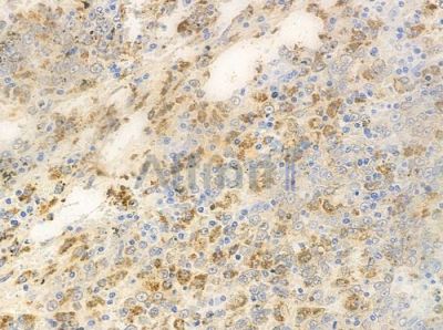 PKC alpha Antibody - AF6196 at 1/100 staining human melanoma by IHC-P.