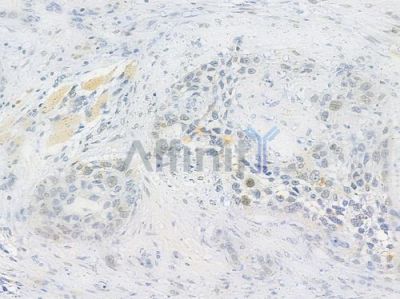 JunD Antibody - AF6200 at 1/100 staining human tongue carcinoma by IHC-P.