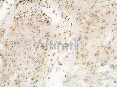Cofilin Antibody - AF6232 at 1/100 staining human breast carcinoma by IHC-P.