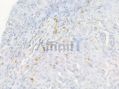 Cyclin D3 Antibody - AF6251 at 1/100 staining human tongue carcinoma by IHC-P.
