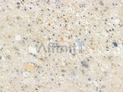 HSF1 Antibody - AF6372 at 1/100 staining human astrocytoma by IHC-P.