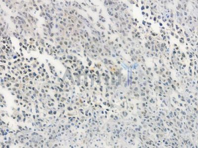 HSF1 Antibody - AF6372 at 1/100 staining human non-Hodgkin lymphoma by IHC-P.