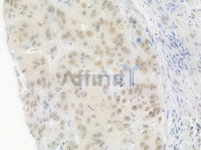 HSF1 Antibody - AF6372 at 1/100 staining human tongue carcinoma by IHC-P.