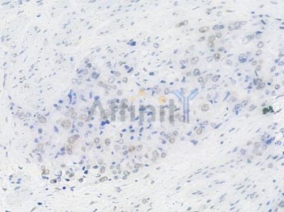 HSF1 Antibody - AF6372 at 1/100 staining human prostate carcinoma by IHC-P.