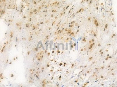 E2F1 Antibody - AF6377 at 1/100 staining human breast carcinoma by IHC-P.