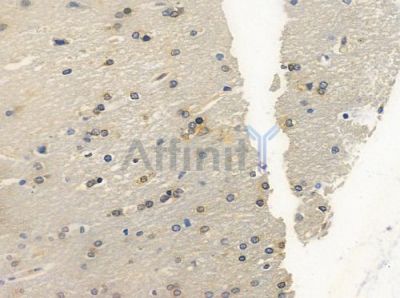 SMC1 Antibody - AF6439 at 1/100 staining human glioblastoma by IHC-P.